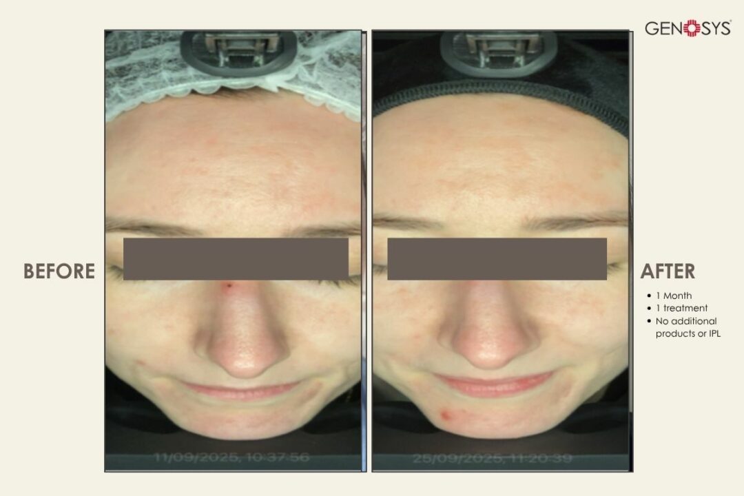 BIO-MESO-1-TREATMENTS