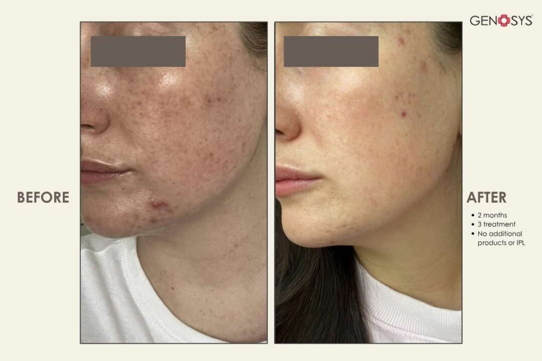 BIO-MESO-3-TREATMENTS