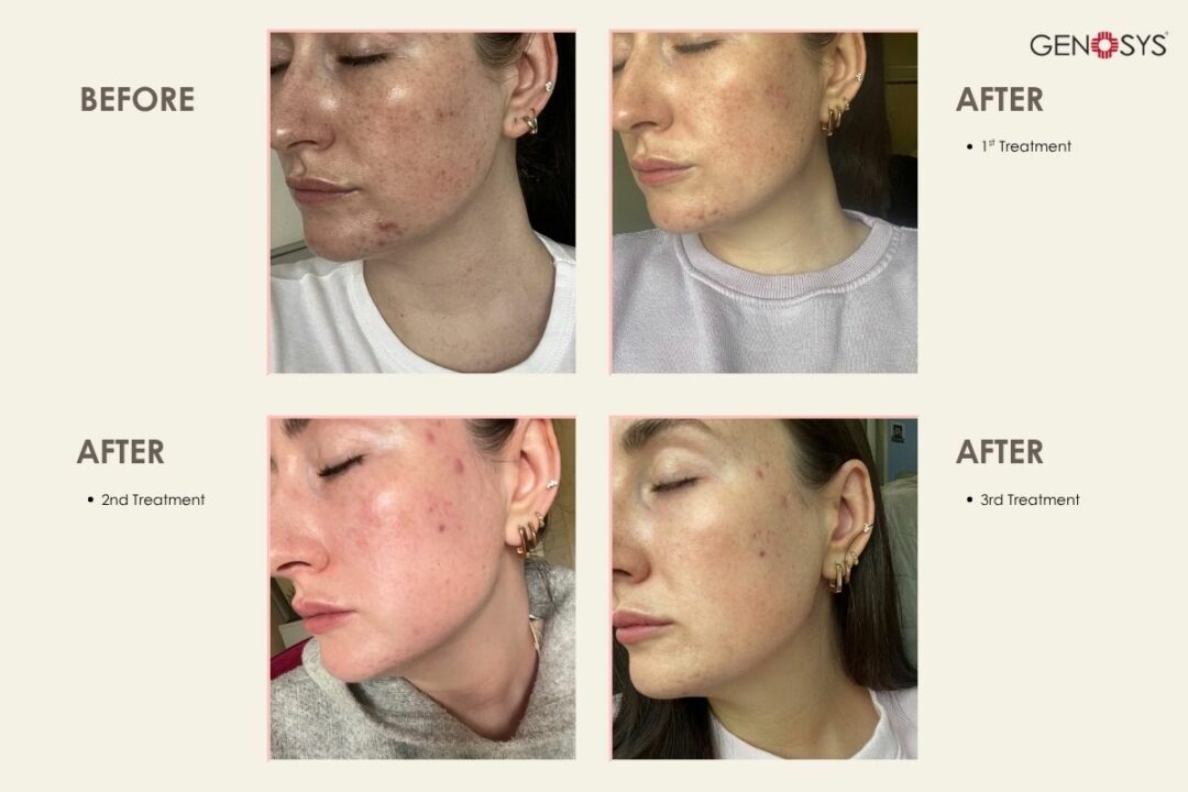 BIO-MESO-COLLECTION-PIC-OF-TREATMENTS