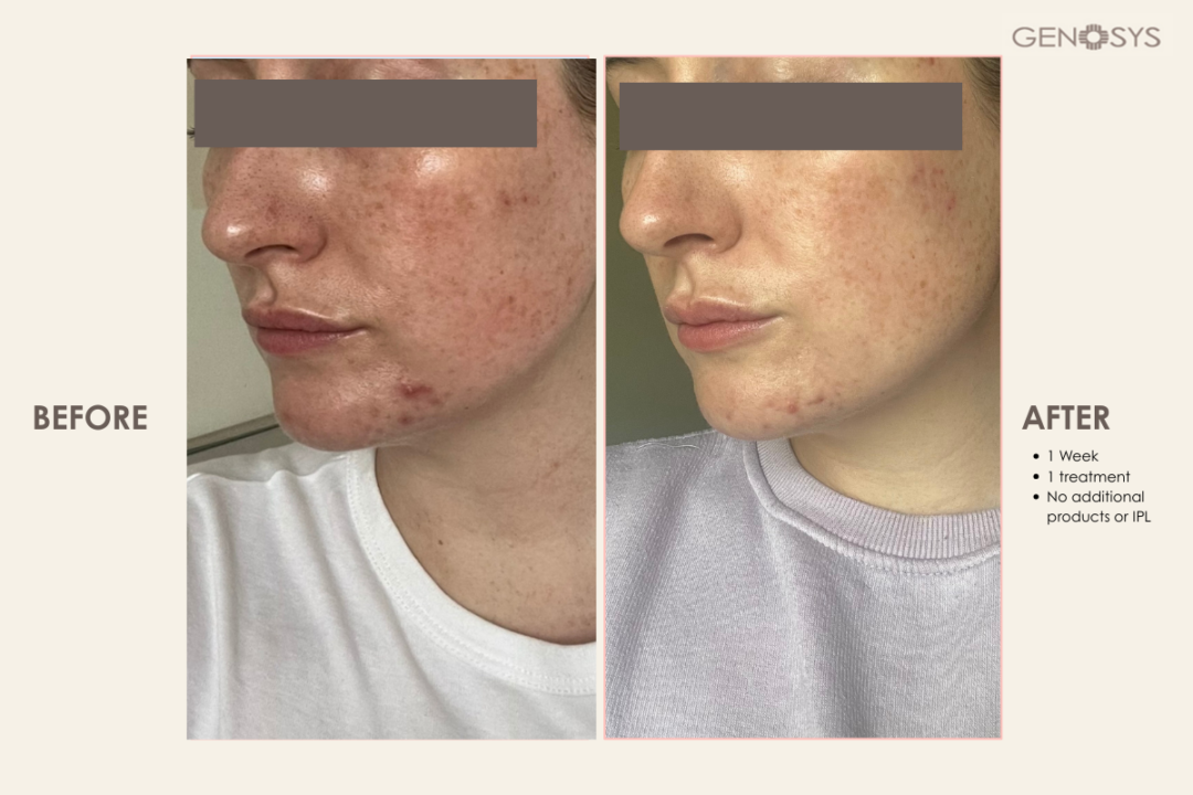 Before-and-After---1-treatment