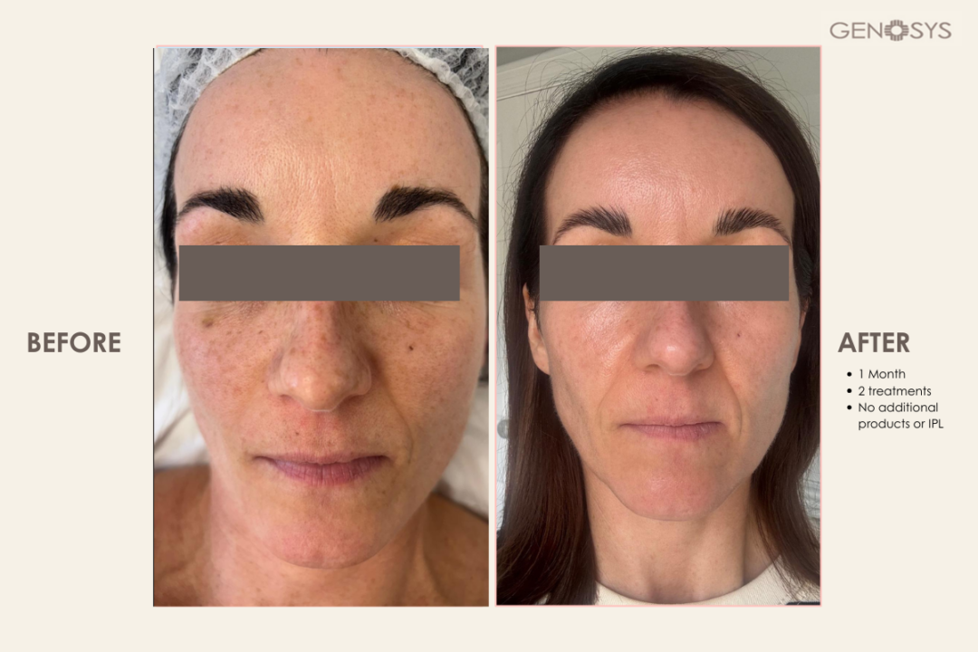 Before-and-After---2-treatments-