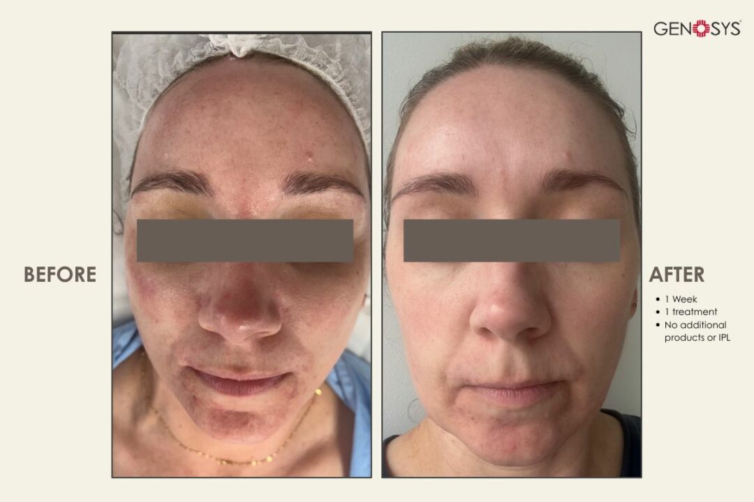 Before-and-after-1-treatment-