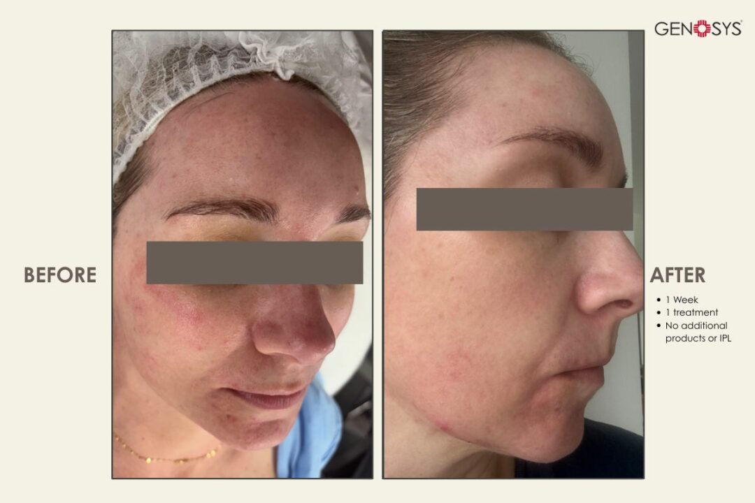 Before-and-after-1-treatment- (1)